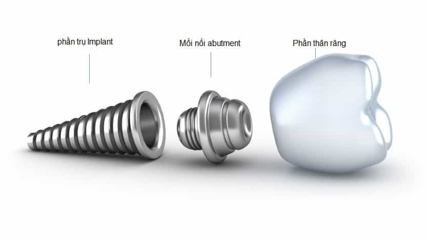 Cấu tạo của răng implant