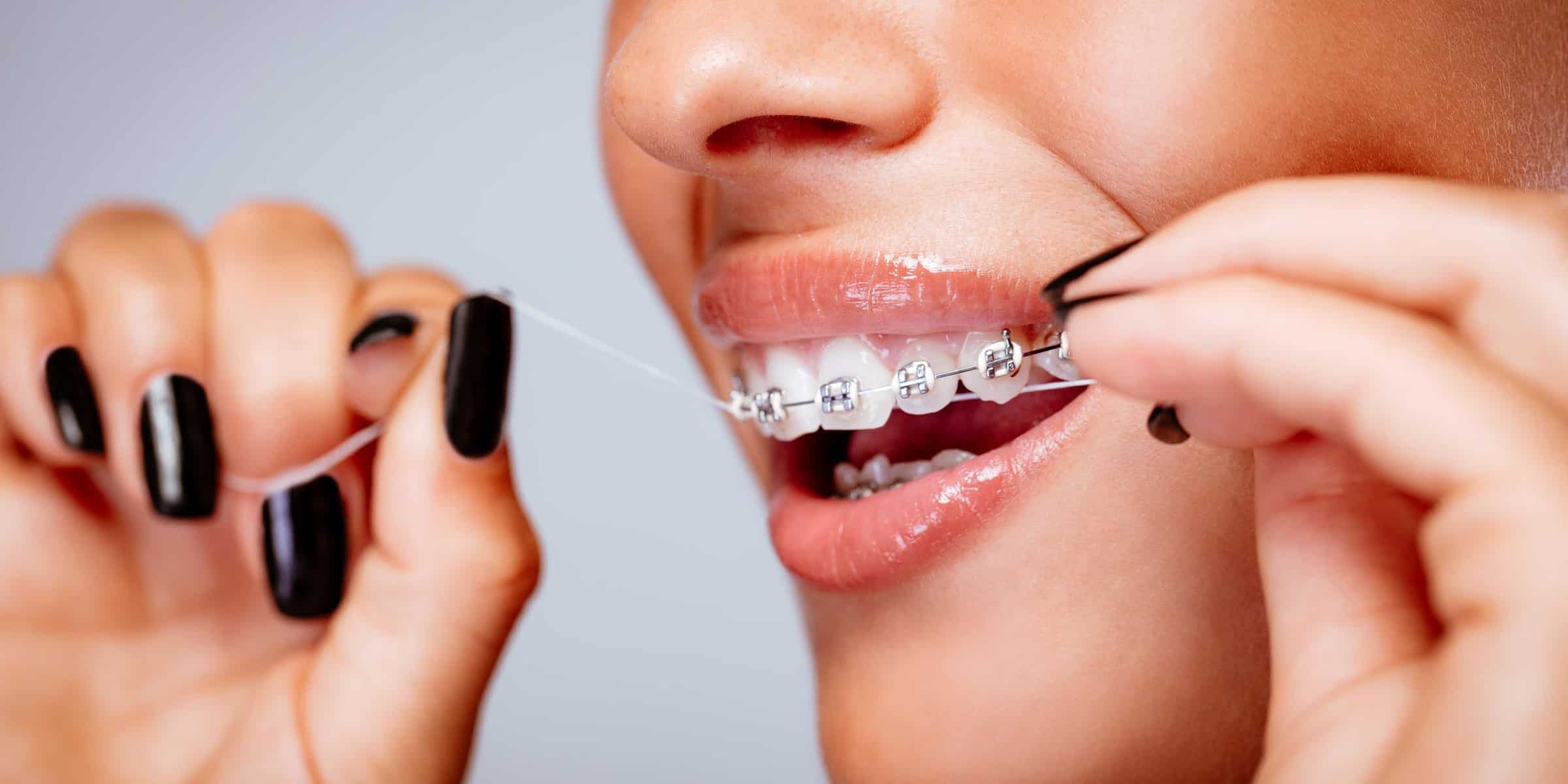 Chăm Sóc Răng Niềng Đúng Cách