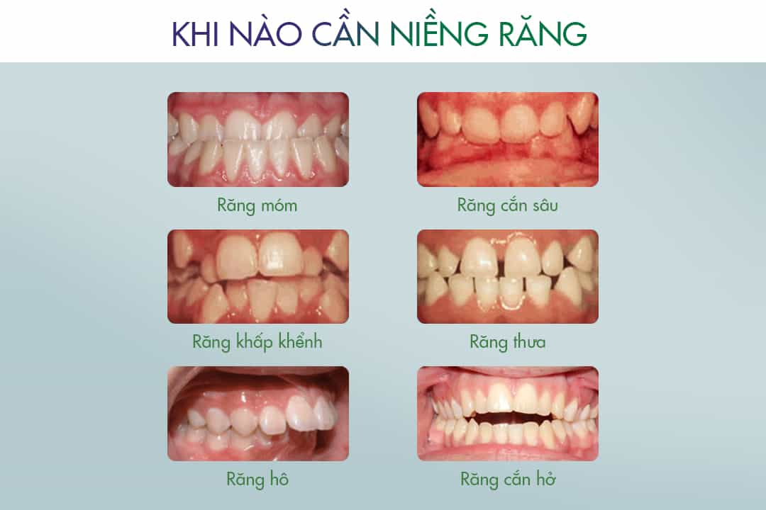 Lựa chọn nha khoa uy tín để niềng răng