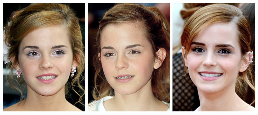 Emma Watson trước và sau khi làm răng