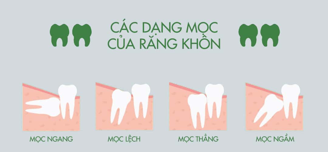 các dạng răng khôn mọc lệch