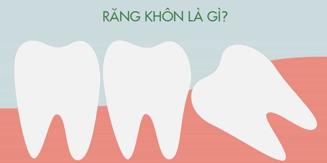 Răng Khôn Là Gì?