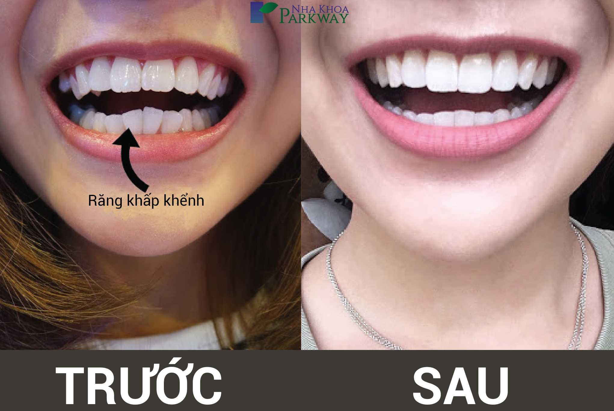 chữa răng khấp khểnh bằng invisalign tại nha khoa parkway