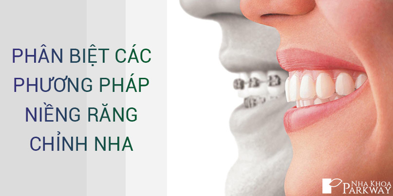 Tổng Hợp Các Phương Pháp Niềng Răng Chỉnh Nha