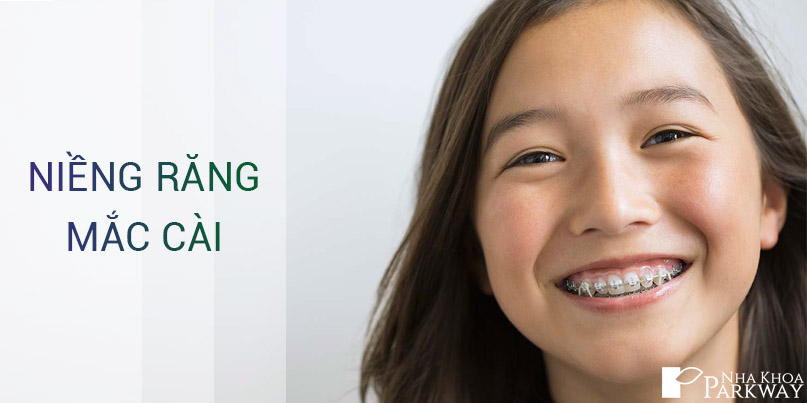 Niềng Răng Mắc Cài