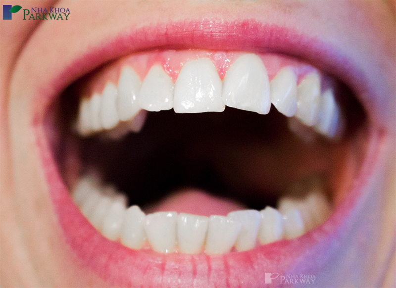 Chữa răng khấp khểnh bằng Invisalign nha khoa Parkway