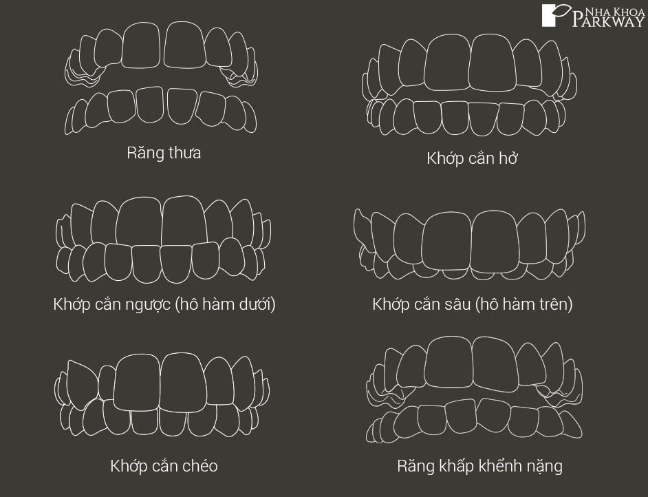 Các dạng khớp cắn niềng invisalign nha khoa parkway