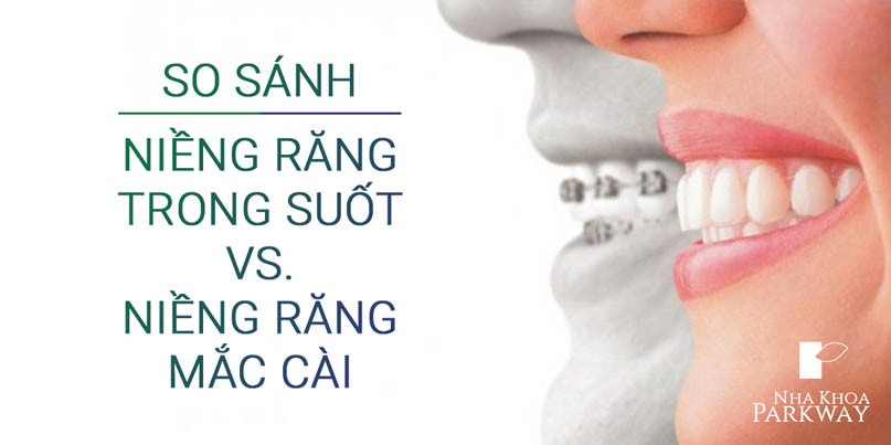 Ưu Điểm Của Niềng Răng Trong Suốt Invisalign So Với Niềng Răng Mắc Cài
