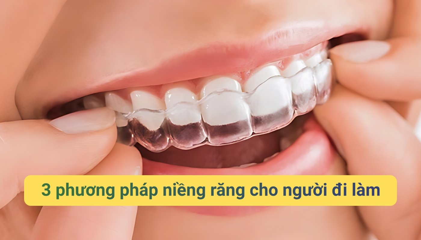 3 phương pháp niềng răng cho người đi làm