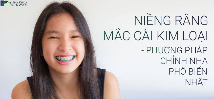 niềng răng mắc cài kim loại nha khoa parkway