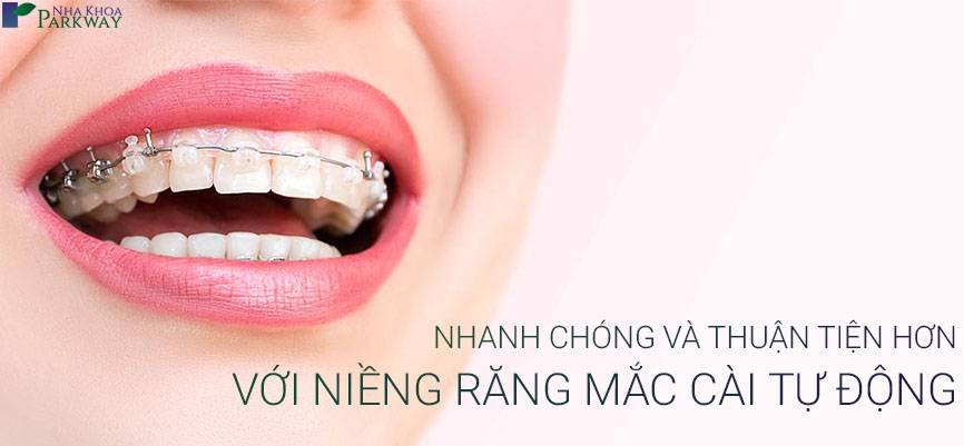 niềng răng mắc cài tự động niềng răng mắc cài tự buộc nha khoa parkway