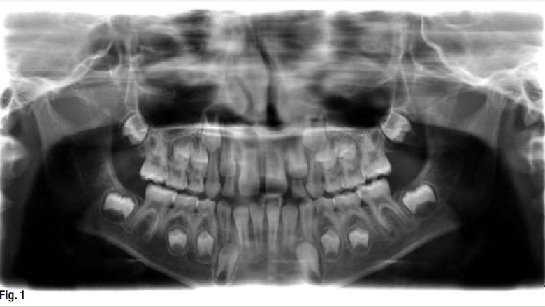 răng sữa giữ chỗ cho răng vĩnh viễn