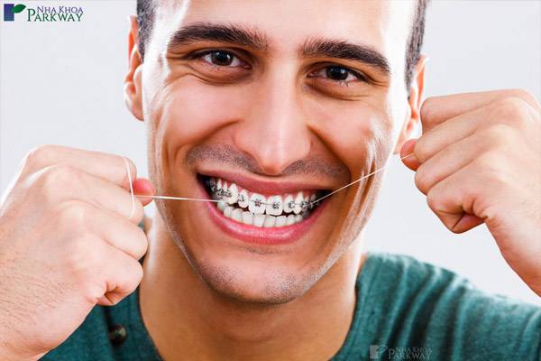 niềng răng mắc cài tự động