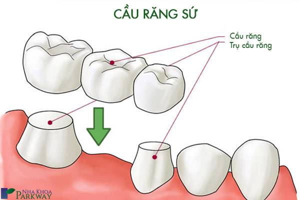 cầu răng sứ bọc răng sứ nha khoa parkway