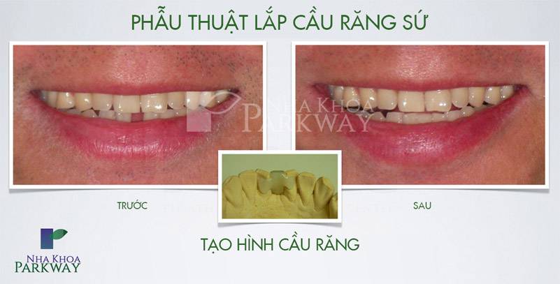 cầu răng sứ bọc răng sứ nha khoa parkway
