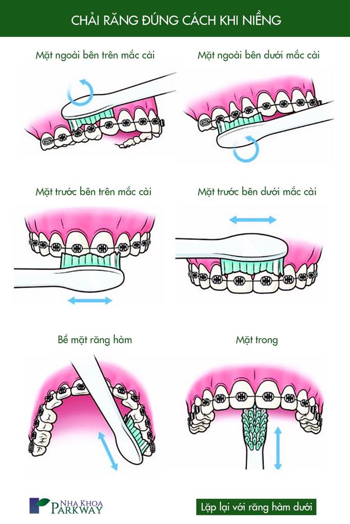 chải răng đúng cách cho người niềng răng