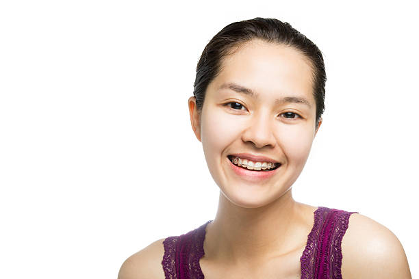 Thực hư chuyện niềng răng hóp má già đi cả chục tuổi