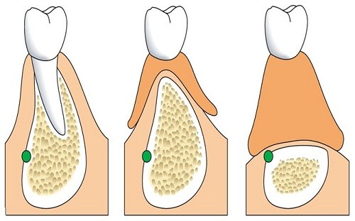 răng giả tháo lắp