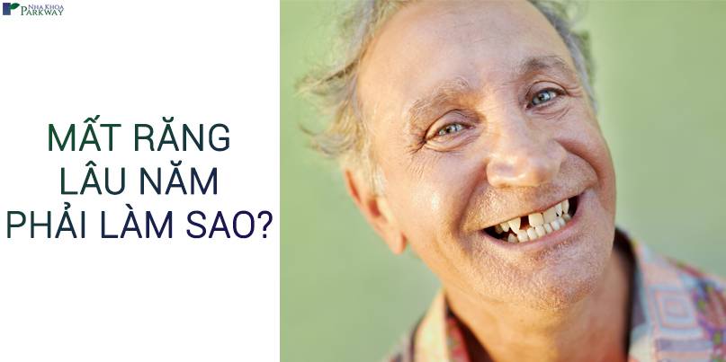 mất răng lâu năm trồng răng implant