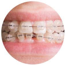 niềng răng mắc cài sứ