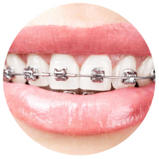 niềng răng mắc cài tự động