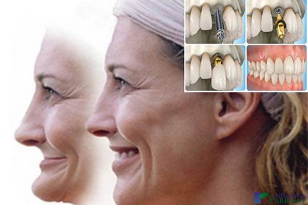 trồng răng implant có nguy hiểm không