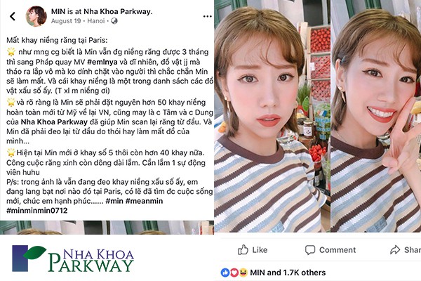 Min_mất_khay_niềng_invi