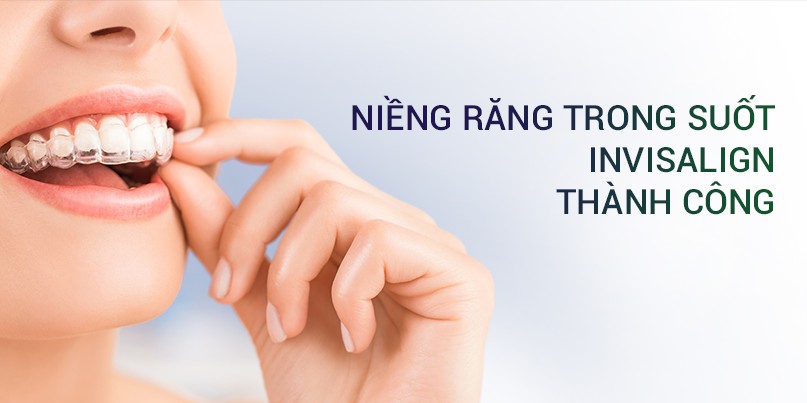 3 yếu tố tạo nên sự thành công của một ca niềng răng trong suốt Invisalign