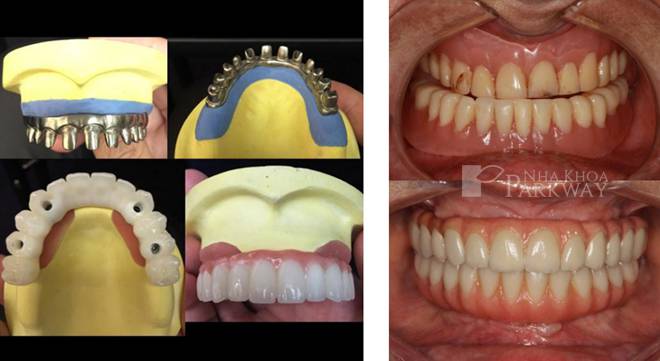 trồng răng implant all on 4 trồng răng giả răng giả toàn hàm