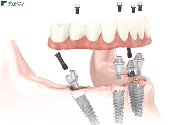 trồng răng implant all on 4 trồng răng giả răng giả toàn hàm