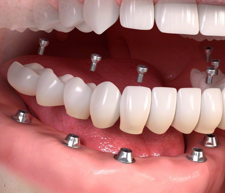 trồng răng implant all on 6 trồng răng toàn hàm mất răng toàn hàm trồng răng giả toàn hàm