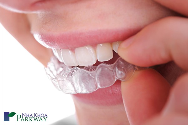niềng_răng_invisalign_có_làm_thay_đổi_giọng_nói