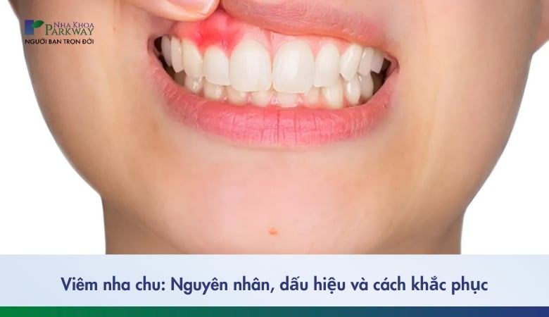 Viêm nha chu: Nguyên nhân và cách khắc phục