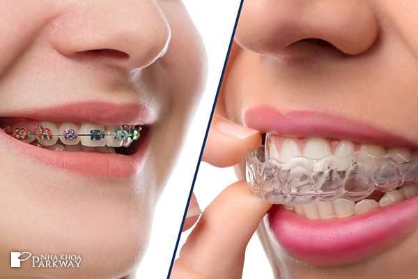 chọn loại mắc cài phù hợp
