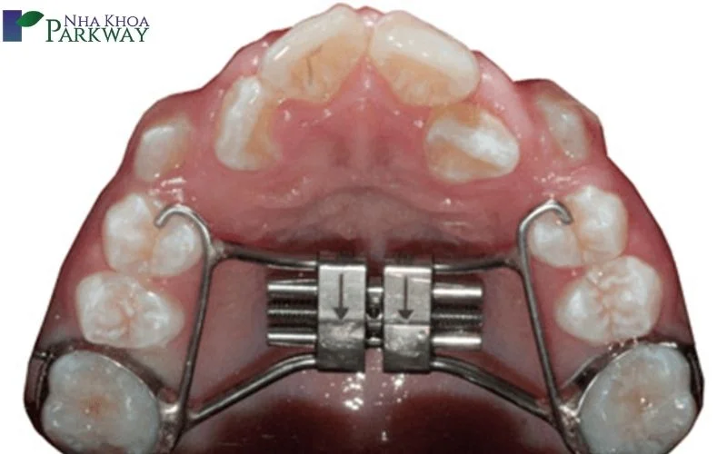 Việc nong hàm sẽ cải thiện mức độ hẹp của vòm hàm