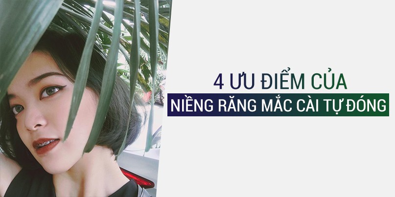 4 ưu điểm của niềng răng mắc cài tự động