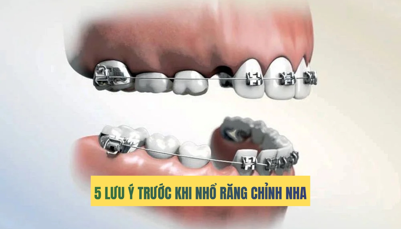 5 lưu ý phải biết khi nhổ răng chỉnh nha