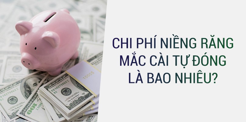 Chi phí niềng răng mắc cài tự động có đắt không?