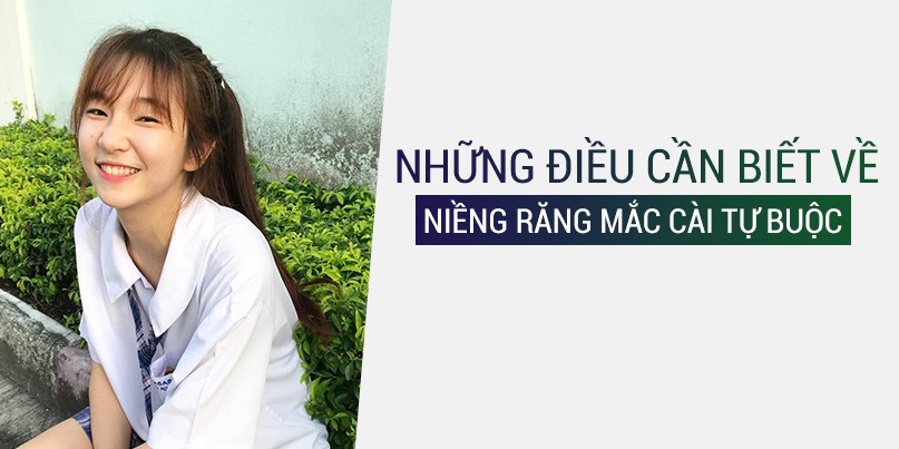 Những điều cần biết về niềng răng mắc cài tự buộc