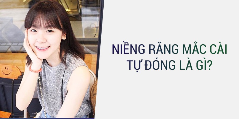 Niềng răng mắc cài tự đóng(tự buộc) là gì?