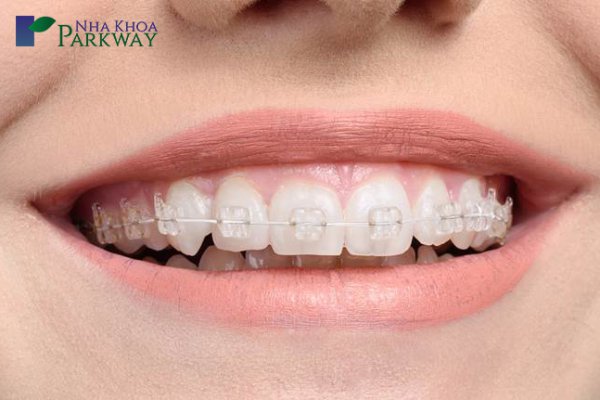 mắc_cài_sứ_dây_trong
