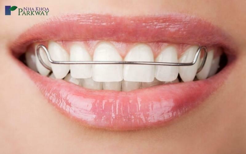 Các câu hỏi thường gặp khi dùng hàm duy trì sau khi niềng răng