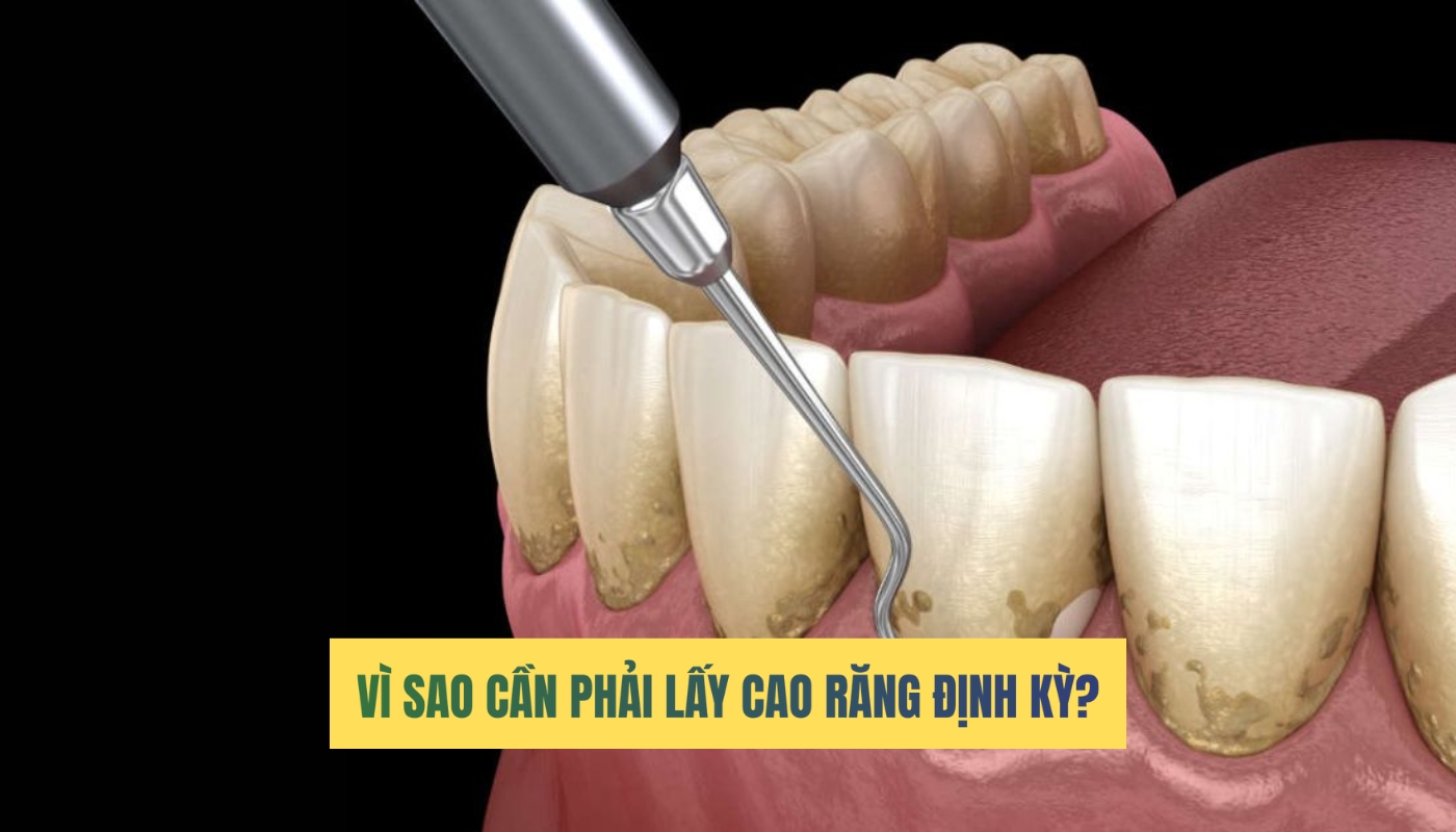 Tác dụng của lấy cao răng