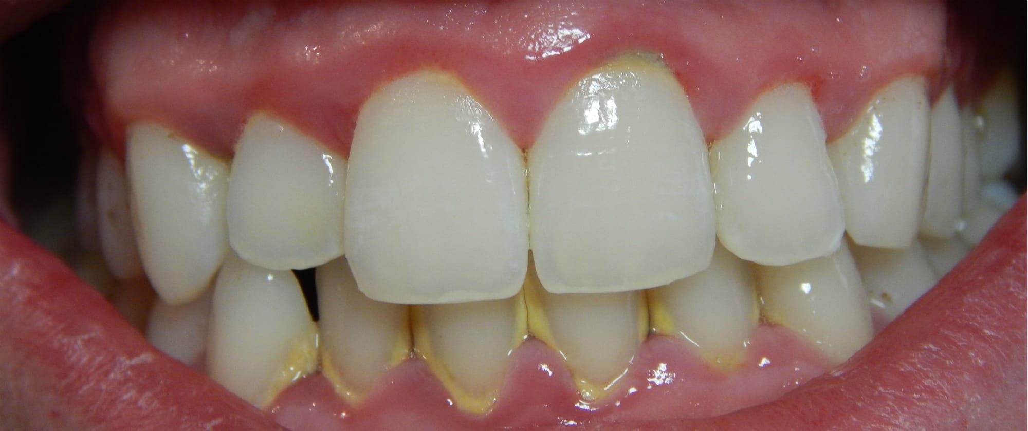 cao_răng_mặt_trước