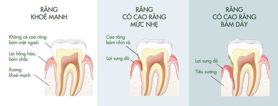 lấy_cao_răng_tốt_không