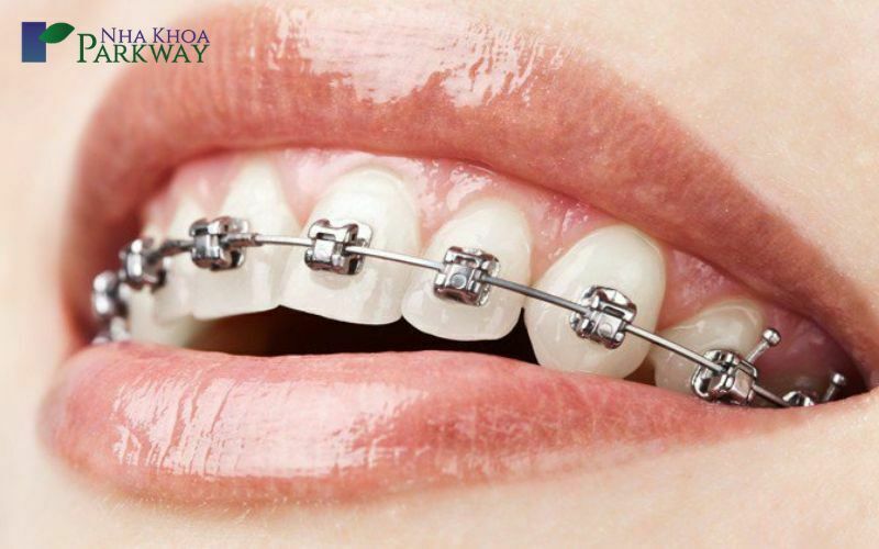Chữa cười hở lợi không cần phẫu thuật bằng phương pháp niềng răng