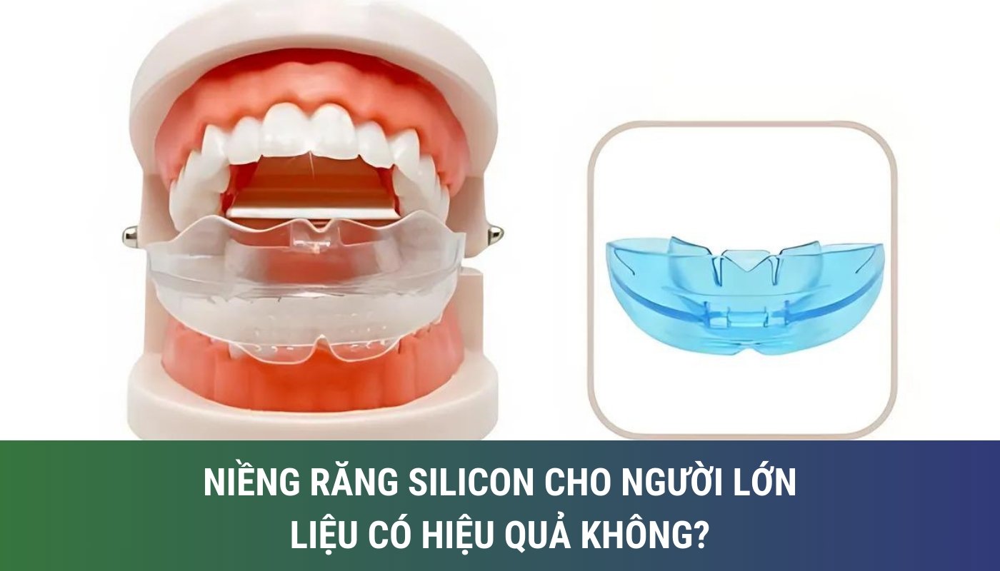 Niềng răng silicon cho người lớn liệu có mang lại hiệu quả?