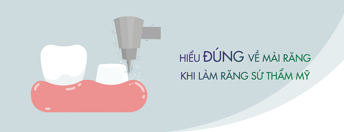 Hiểu Đúng Về Mài Răng Khi Làm Răng Sứ Thẩm Mỹ