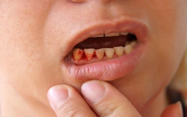 chảy máu chân răng gây hôi miệng