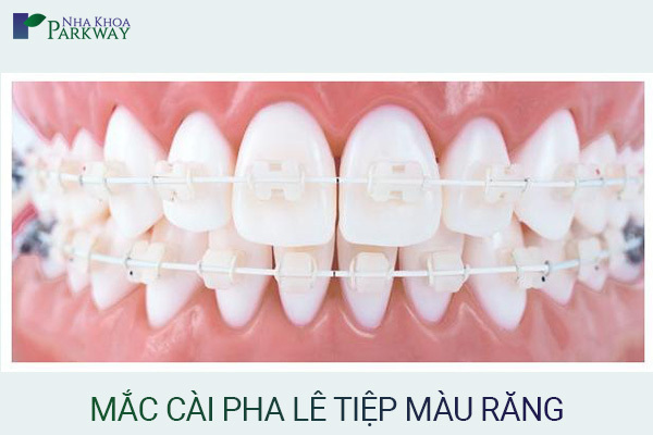 niềng răng mắc cài pha lê